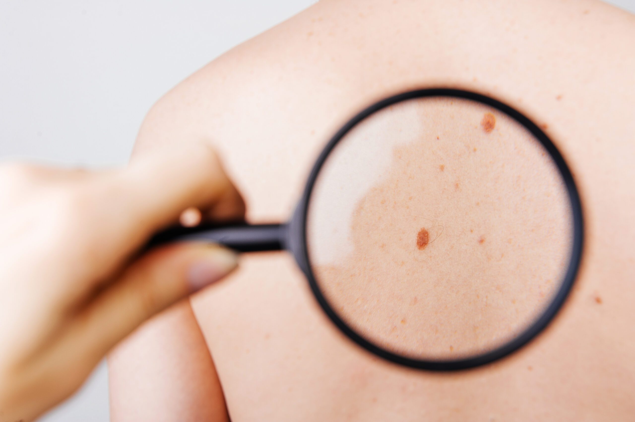 Dermatologist,Examining,Birthmark,Of,Patient,,Closeup.,Cancer,Concept